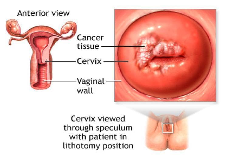 This composite educational illustration demonstrates the anatomy of the female reproductive system and the clinical presentation of cervical cancer. The left side features a frontal (anterior) cross-sectional diagram of the internal reproductive organs, labeling the uterus, bilateral fallopian tubes, ovaries, cervix, and the ribbed vaginal wall. The right side contains a detailed clinical illustration of the cervix as viewed through a speculum, with the patient in the lithotomy position (indicated by a small inset icon). This view highlights a pathological lesion labeled as 'Cancer tissue.' The malignant tissue is depicted as an irregular, exophytic, and cauliflower-like growth with a whitish-pink, granular texture, contrasting against the smooth, reddish-pink surface of the healthy ectocervix. The lesion is localized primarily on the left side of the cervical os. This resource is designed for gynecological education to assist in the identification of gross cervical abnormalities and understanding spatial anatomical relationships during pelvic examinations.