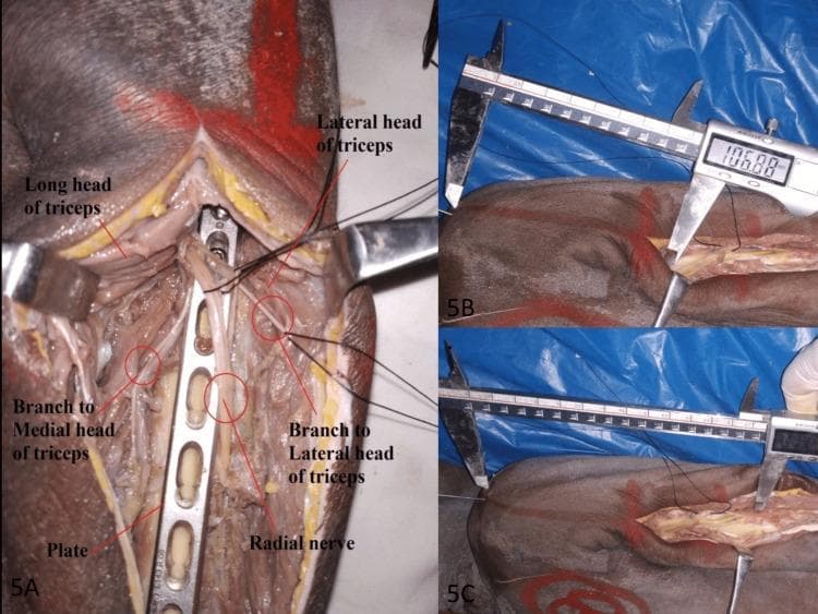 A composite of three clinical photographs demonstrating an anatomical dissection and surgical fixation of the humerus. Panel A provides a high-detail posterior view of the proximal arm. A distal humeral locking compression plate is fixed to the posterior humerus. The dissection clearly identifies the radial nerve as it traverses the spiral groove, showing its anatomical relationship to the surgical hardware. Labels highlight the long and lateral heads of the triceps brachii muscle, as well as specific muscular branches of the radial nerve to the medial and lateral heads. Panels B and C illustrate the quantitative morphometric analysis of the radial nerve's course. A digital Vernier caliper is shown measuring distances from a proximal bony landmark (identified as the posterolateral tip of the acromion) to the points where the radial nerve crosses the medial and lateral borders of the humerus. These images illustrate surgical anatomy relevant to posterior humeral plating and the prevention of iatrogenic radial nerve injury during orthopedic procedures.