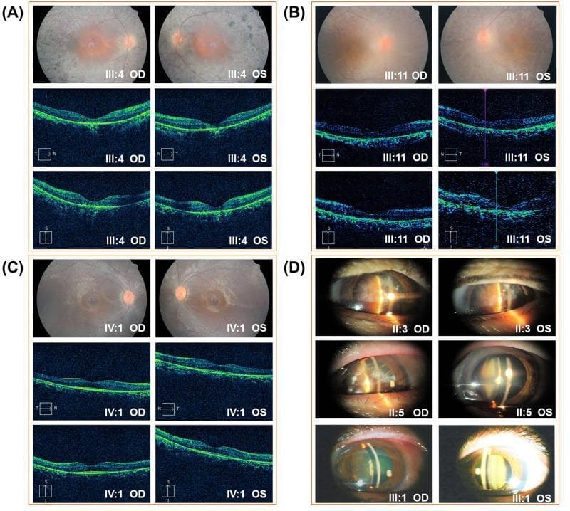 A multi-panel compilation of ophthalmic clinical images featuring fundus photography, Optical Coherence Tomography (OCT), and slit-lamp biomicroscopy. Panels A, B, and C display bilateral fundus photos and corresponding macular OCT scans for three patients (III:4, III:11, and IV:1). Fundus findings show classic signs of Retinitis Pigmentosa (RP), including bone-spicule pigmentation, retinal pigment epithelium (RPE) atrophy, and marked attenuation of retinal vessels, most notably in III:4 and III:11. The corresponding OCT images demonstrate progressive retinal thinning and loss of the outer retinal layers (ellipsoid zone and photoreceptor segments). Panel D presents slit-lamp photographs of the anterior segment for patients II:3, II:5, and III:1, illustrating varying degrees of crystalline lens opacification. Observed cataract morphologies include central nuclear sclerosis with a yellowish hue (II:3) and more diffuse cortical or subcapsular opacities (II:5). These images provide a clinical overview of the ophthalmic manifestations associated with autosomal dominant Retinitis Pigmentosa, including secondary cataract formation, across multiple family members.