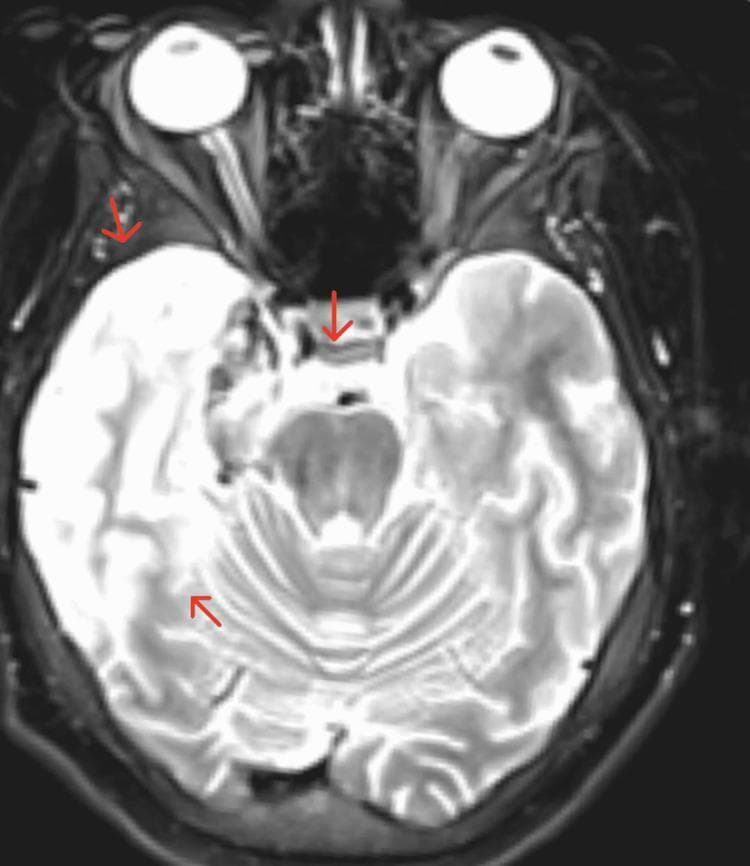 An axial T2-weighted MRI scan of the brain with contrast, demonstrating significant findings characteristic of Herpes Simplex Encephalitis (HSE). The image reveals marked signal alteration in the right hemisphere, specifically involving the mesial temporal lobe and limbic system. Key features include contrast enhancement and evidence of hemorrhagic transformation, indicated by mixed signal intensities within the affected parenchyma. Red arrows highlight the involvement of the right limbic structures, the fornix, and the right optic radiation. Anatomical consequences include mild effacement of the right lateral ventricle and a minimal leftward midline shift, suggesting localized mass effect and cerebral edema. This diagnostic image illustrates the classic predilection of HSV-1 for the temporal lobes and its potential for hemorrhagic evolution, which can lead to complications such as increased intracranial pressure and visual pathway deficits.