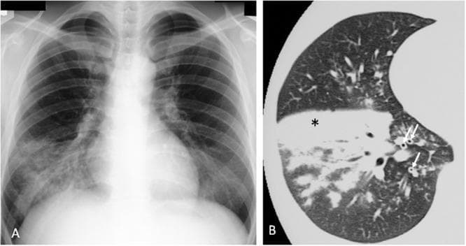 A multi-modal diagnostic comparison illustrating Mycoplasma pneumoniae pneumonia. Image A is a posterior-anterior chest x-ray showing increased density and reticulonodular infiltrates primarily localized in the right lower lobe, signifying an active infectious process. Image B is a high-resolution computed tomography (HRCT) scan axial slice of the lung parenchyma. The HRCT demonstrates a dense region of lobar consolidation, marked with an asterisk (*), indicating alveolar filling. Additionally, arrows (↑) highlight significant bronchovascular bundle thickening, characterized by increased interstitial markings and peribronchial cuffing. The combination of these radiological findings reflects the classic presentation of atypical pneumonia, emphasizing the correlation between plain film radiography and the superior anatomical detail provided by cross-sectional CT imaging for evaluating pulmonary inflammation and consolidation.