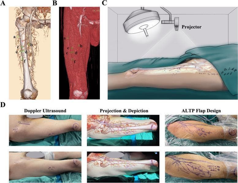 This composite educational image illustrates the multi-step process of using Augmented Reality (AR) for preoperative Anterolateral Thigh Perforator (ALTP) flap design. (A) Three-dimensional CT angiography (CTA) reconstruction of the thigh showing the skeletal framework and vascular network, with six specific perforator emergence points (a-f) marked. (B) Volume-rendered CTA focusing on the muscular anatomy, showing the same markings relative to the muscle surface. (C) A clinical diagram depicting a portable projector mapping the reconstructed vascular map onto a patient’s thigh in the preoperative setting. (D) A clinical photograph sequence demonstrating the practical application: initial Doppler ultrasound marking of perforators, followed by 'Projection & Depiction' where the AR map is overlaid on the skin to align with anatomical landmarks like the patella and ASIS, and finally the 'ALTP Flap Design' where the surgical incision lines are drawn based on the projected vascular course and perforator locations. This demonstrates an advanced surgical planning technique in reconstructive microsurgery to increase the accuracy of flap harvesting.