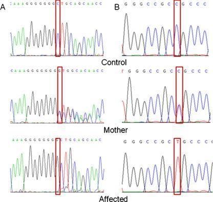 This diagnostic image displays DNA sequence chromatograms from Sanger sequencing, illustrating genetic mutations in the PCFT gene associated with Hereditary Folate Malabsorption. The content is organized into two panels, A and B, each comparing a wild-type Control, a heterozygous Mother, and a homozygous Affected individual. Panel A demonstrates a frameshift mutation (c.194dupG) in exon 1. The control shows clear single peaks; the mother exhibits overlapping peaks (double trace) following the mutation site indicating heterozygosity; the affected individual shows a distinct shift and overlapping peaks from the insertion point. Panel B illustrates a missense mutation (c.340C>T) in exon 2. The red boxes highlight the specific nucleotide position: the control shows a single blue peak (C), the mother shows overlapping blue (C) and red (T) peaks, and the affected individual shows a single red peak (T). This comparison serves as an educational tool for identifying different inheritance patterns (heterozygous vs. homozygous) and mutation types (frameshift vs. point mutation) in clinical genetics.