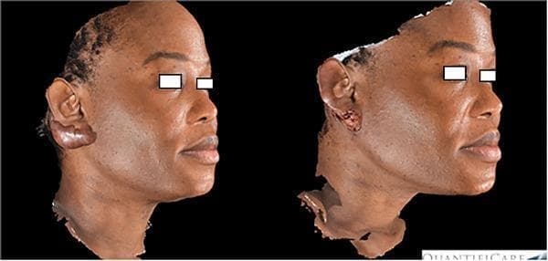 Side-by-side comparison of 3D digital clinical images (Quantificare system) showing a patient with a prominent earlobe keloid before and immediately after CO2 laser treatment. In the 'before' image (left), a large, smooth, pedunculated keloid mass is visible, significantly distorting the natural anatomy of the right earlobe. The patient has a high Fitzpatrick skin phototype. In the 'after' image (right), the bulky keloid has been ablated, resulting in a dramatic reduction in lesion volume. The treatment site shows immediate post-operative changes, including a raw, slightly uneven surface texture with pinpoint bleeding and removal of the primary mass, restoring the approximate contour of the earlobe. The images illustrate the efficacy of CO2 laser ablation in treating hypertrophic and keloid scarring in dermatological practice, particularly for complex anatomical areas like the ear helix and lobe.