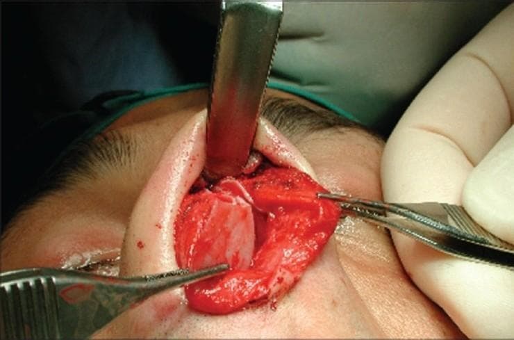 This clinical photograph captures an intraoperative view of an open rhinoplasty procedure, demonstrating a severe fracture-dislocation of the nasal septum in a 20-year-old male patient. The image shows the internal nasal structures exposed following the elevation of the nasal skin envelope. The nasal septum exhibits a clear transverse fracture, with a significant segment of the septal cartilage displaced from its anatomical midline position. Surgical exposure is maintained using an Aufricht retractor superiorly to lift the soft tissue, while two pairs of surgical forceps are used laterally for tissue stabilization and manipulation of the fractured septal segments. The visual highlights the complexity of post-traumatic secondary nasal deformity, specifically the disruption of the internal nasal valve and the loss of cartilaginous support. This clinical case illustrates the necessity for surgical reduction and reconstructive techniques, such as the use of spreader grafts, to restore functional airway patency and aesthetic nasal structure.
