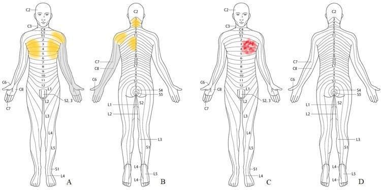 A series of four schematic anatomical diagrams (A-D) illustrating dermatomal distributions of pain and numbness on human figures. Panels A (anterior) and B (posterior) show preoperative cervical radiculopathy symptoms, with yellow shading indicating persistent pain in the neck (C2-C3), bilateral upper chest (C4-T4), left shoulder, and left subscapular area. Gray shading on the left upper extremity represents numbness involving the arm and all digits (C6-C8 distribution). Panels C (anterior) and D (posterior) illustrate postoperative symptoms following cervical surgery. A red shaded area on the left anterior chest (spanning approximately C3-T4 dermatomes) represents the location of angina pectoris pain. The diagrams use standard dermatome labeling (C2-S5) to map clinical sensory manifestations. This medical illustration is used to differentiate between cervical referred pain and cardiac-origin chest pain in a clinical context, highlighting the importance of sensory mapping in differential diagnosis.