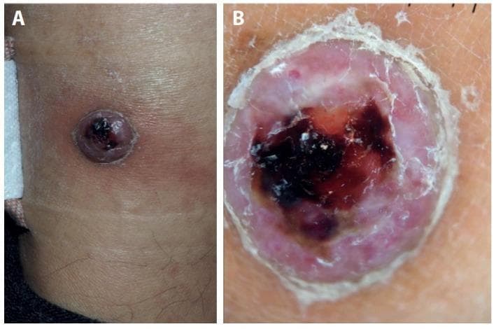 This composite image consists of a clinical photograph (A) and a dermoscopic image (B) of a solitary skin lesion on the ankle, demonstrating clinical features that mimic pyogenic granuloma but histopathologically confirmed as myopericytoma. Panel A shows a well-circumscribed, raised, dome-shaped nodule with a multi-colored surface. The lesion exhibits a central dark, violaceous to black crust indicative of hemorrhage or necrosis, surrounded by an erythematous, fleshy peripheral zone. Panel B provides a dermoscopic view revealing a characteristic pattern of homogeneous white-red areas. The center contains dark red to black blood lakes. A prominent, peripheral whitish collarette of scales is visible at the edge of the lesion, which is a key diagnostic feature for vascular tumors like pyogenic granuloma. The surrounding skin shows mild peri-lesional erythema. This comparison illustrates the visual overlap between benign vascular proliferations and rare perivascular tumors like myopericytoma, emphasizing the importance of histopathological correlation for definitive diagnosis.