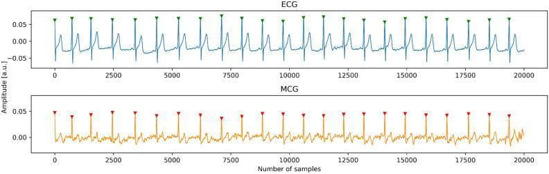 This Comparison Chart illustrates simultaneous cardiac signal recordings, comparing Electrocardiography (ECG) and Magnetocardiography (MCG) over a continuous sample range of 0 to 20,000 samples. The top panel displays the ECG waveform in blue, showing a clear rhythmic pattern characterized by prominent QRS complexes and distinct T waves, with amplitude ranging approximately between -0.05 and 0.05 arbitrary units (a.u.). The bottom panel displays the MCG waveform in orange, which tracks the cardiac rhythm synchronously with the ECG but exhibits a more complex, less defined morphology with amplitude fluctuations between roughly -0.02 and 0.05 a.u. Both signals are annotated with triangular fiducial markers—green for ECG and red for MCG—placed at the apex of each R-wave. These markers facilitate the analysis of temporal alignment and heart rate variability between the electric and magnetic manifestations of the cardiac cycle. This artifact-free recording is utilized in cardiology research to study the synchronization and morphological differences between bioelectric potentials and biomagnetic fields in healthy human subjects.
