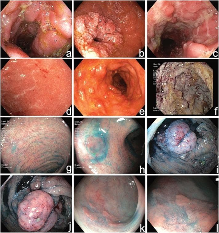 This composite of twelve endoscopic images (a-l) demonstrates high-resolution video endoscopy findings in Inflammatory Bowel Disease (IBD). Panels a-f utilize standard white-light endoscopy for initial diagnosis, showcasing various disease manifestations: (a) acute terminal ileitis in Crohn's disease with mucosal edema; (b) duodenal Crohn's stenosis with significant luminal narrowing; (c) segmental fissural ulcerations in the colon; and (d-f) progressive severity of ulcerative colitis (UC) ranging from mild erythema (UCEIS 3) to severe mucosal architectural distortion and deep ulceration (UCEIS 8). Panels g-l demonstrate surveillance colonoscopy using chromoendoscopy with 0.1% indigocarmine dye. The dye highlights surface topography: (g) normal mucosal pit patterns; (h) a small flat hyperplastic polyp; (i-j) elevated pseudopolyps; and (k-l) a flat, inhomogeneous polypoid lesion. Frame (l) employs near-focus imaging to reveal subtle mucosal irregularities characteristic of high-grade intraepithelial neoplasia. This comparison illustrates the utility of chromoendoscopy in enhancing contrast for better detection of dysplastic lesions during IBD surveillance compared to conventional white-light imaging.
