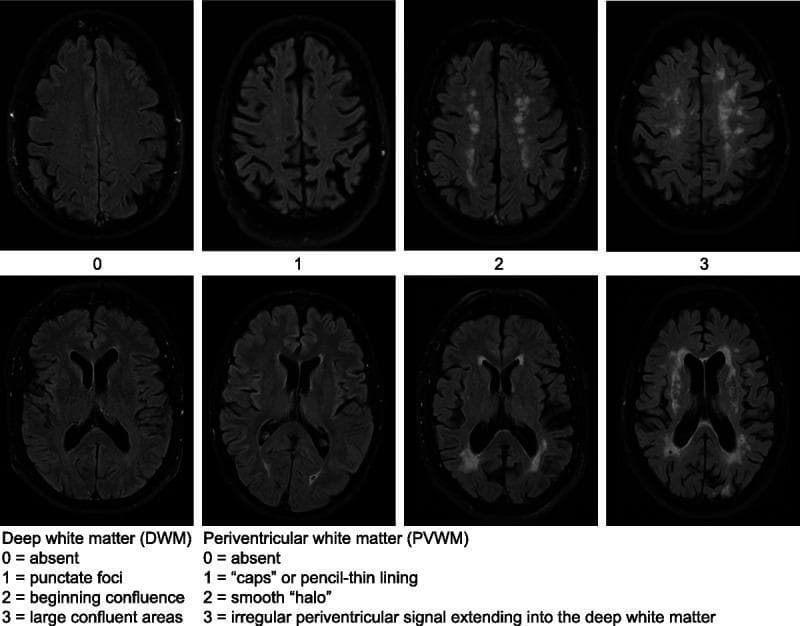 This diagnostic comparison chart illustrates the Fazekas scale for grading white matter hyperintensities (WMH) using axial FLAIR (Fluid-Attenuated Inversion Recovery) MRI sequences. The image is divided into two rows representing distinct anatomical regions: Deep White Matter (DWM) and Periventricular White Matter (PVWM). The DWM row (top) demonstrates progression from Grade 0 (absent) to Grade 1 (punctate foci), Grade 2 (beginning confluence), and Grade 3 (large confluent areas). The PVWM row (bottom) depicts clinical stages starting from Grade 0 (absent) to Grade 1 (periventricular 'caps' or pencil-thin lining), Grade 2 (smooth 'halo' around ventricles), and Grade 3 (irregular hyperintensities extending into the deep white matter). This radiological tool is essential in neurology and neuroradiology for quantifying chronic small vessel disease, vascular dementia, and age-related white matter changes. The visual highlights key morphological differences in signal intensity and distribution used to standardize clinical reporting and research outcomes.