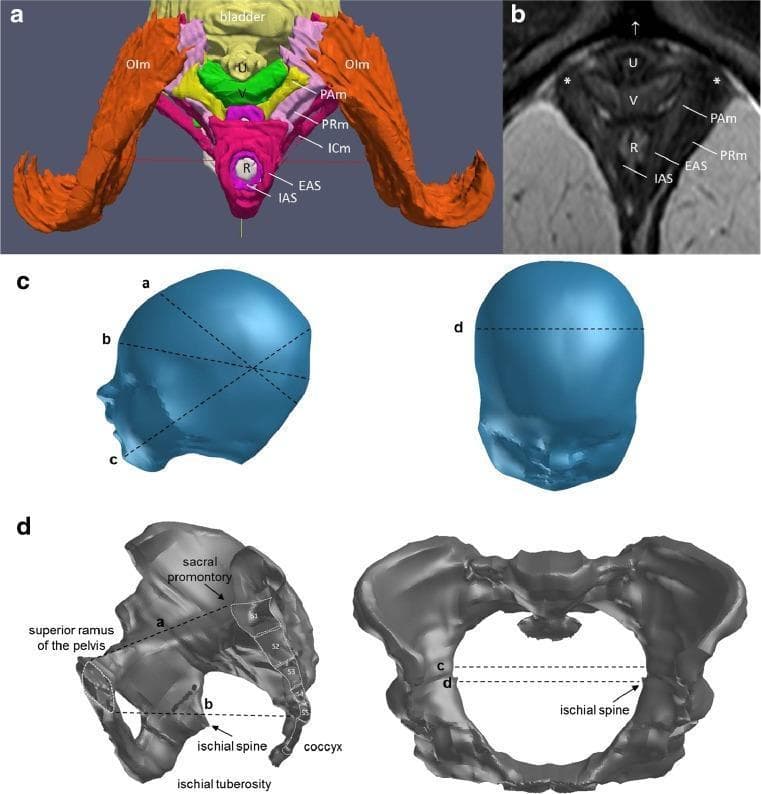 A multi-panel figure illustrating female pelvic anatomy and fetal head dimensions for obstetric study. Panel A: A color-coded 3D inferior view of the Levator Ani Muscle (LAM) complex. Key structures include the obturator internus (orange), puborectal muscle (light purple), iliococcygeus (dark red), and puboanal muscle (yellow). Central visceral structures are labeled: urethra (yellow), vagina (green), and rectum (gray), flanked by the internal (purple) and external (pink) anal sphincters. Panel B: A corresponding axial T2-weighted MRI of the female pelvis confirming the spatial orientation of the urethra (U), vagina (V), and rectum (R), with markers for the pubic bone attachment (asterisk). Panel C: 3D models of a fetal head defining principal obstetric diameters, including suboccipitobregmatic and biparietal dimensions. Panel D: 3D reconstructions of the female bony pelvis in lateral and axial views, marking the pelvic inlet, outlet, and interspinous diameters. This educational figure integrates radiological findings with anatomical modeling to describe pelvic floor relationships relevant to childbirth mechanics.