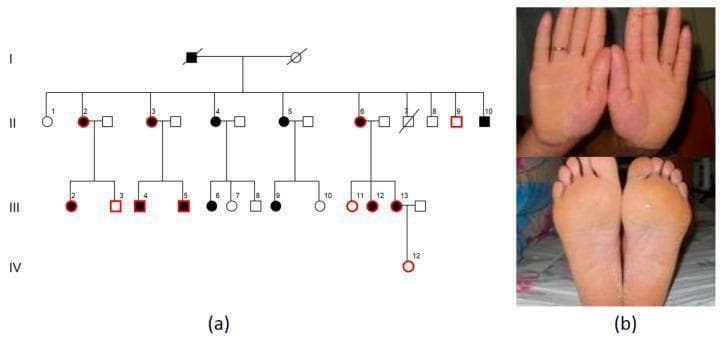 The visual content consists of two parts: a genetic pedigree (a) and clinical photographs (b). The pedigree charts an autosomal dominant inheritance pattern across four generations of a family affected by palmoplantar keratoderma (PPK), with black symbols representing affected individuals. The clinical photographs show the palms and soles of an affected patient. The skin exhibits diffuse, soft, yellowish hyperkeratosis spanning the entire surface of both palms and soles. Notable features include a smooth but thickened texture and evidence of keratolysis (breakdown of the keratin layer). The margins of the keratoderma lack a sharp demarcation line, showing a gradual transition to unaffected skin at the borders. There is no evidence of severe inflammatory erythema or deep fissuring in this specific manifestation. This visual is characteristic of diffuse palmoplantar keratoderma, an inherited skin disorder used for medical education in dermatology and clinical genetics to demonstrate phenotypic manifestations and pedigree analysis.