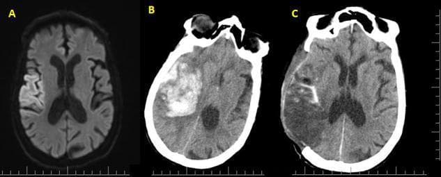 This Comparison Chart consists of three axial brain scans (MRI and CT) documenting the clinical progression and surgical management of a right middle cerebral artery (MCA) infarction. Image A is an axial T2-FLAIR MRI showing hyperintense signals in the right cortical region, consistent with early cytotoxic edema and acute ischemic stroke. Image B is a non-contrast CT scan taken 24 hours later, revealing a massive, hyperdense intracerebral hematoma within the infarcted area. This hemorrhagic transformation demonstrates significant mass effect, leading to subfalcine herniation and a distinct leftward midline shift. Image C is a post-operative CT scan following a decompressive hemicraniectomy (DHC) and hematoma evacuation. Key features include a large right-sided skull defect, reduced hematoma volume, and improvement in the midline shift, though residual parenchymal distortion and encephalomalacia persist. This sequence serves as an educational tool for neurosurgery and neuroradiology, illustrating the complications of large-vessel ischemia and the radiological appearance of life-saving surgical decompression.
