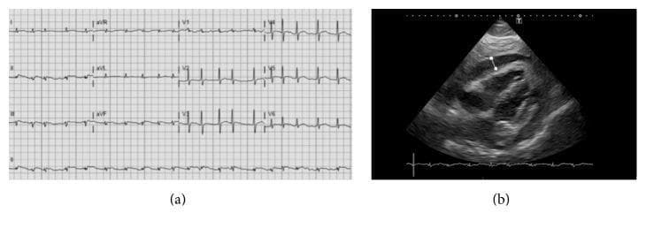 The composite image displays two diagnostic modalities evaluating acute pericarditis progressing to cardiac tamponade. Panel (a) shows a twelve-lead electrocardiogram (ECG) demonstrating atrial fibrillation characterized by an irregularly irregular rhythm and absent P-waves. Notable findings include low-voltage QRS complexes across both limb and precordial leads, which is a clinical sign of electrical insulation due to fluid accumulation. Panel (b) is a subcostal view cardiac ultrasound (echocardiogram) revealing a large circumferential pericardial effusion. A white measurement marker indicates an effusion depth exceeding 20 mm. Within the hypoechoic pericardial space, dense echogenic structures and fibrinous strands are visible, suggesting purulent or exudative pericarditis (e.g., meningococcal origin). The combination of low-voltage ECG and large effusion on ultrasound is highly suggestive of impending cardiac tamponade.