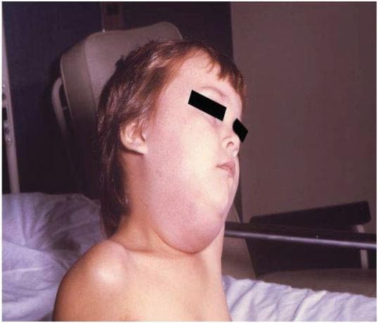 Clinical photograph of a pediatric patient presenting with marked, unilateral swelling of the right parotid region, characteristic of acute mumps parotitis. The image shows a prominent, non-fluctuant bulge extending from the preauricular area, anterior to and below the ear, down to the angle of the mandible and upper cervical region. This localized edema results in the loss of the normal mandibular line and causes the earlobe to be displaced upward and outward. The overlying skin appears taut and mildly erythematous, indicating significant inflammatory glandular enlargement. This finding is the pathognomonic clinical sign of mumps virus infection (Paramyxoviridae family). The visual evidence supports educational recognition of salivary gland pathology and infectious disease manifestations in children. Differential diagnoses for such clinical presentations include bacterial parotitis, salivary calculi, or other viral etiologies like influenza or Epstein-Barr virus.