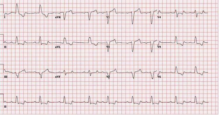 This diagnostic image is a 12-lead electrocardiogram (ECG) printed on standard grid paper, demonstrating dynamic changes consistent with Left Bundle Branch Block (LBBB) in the context of hyperkalemia management. The tracing shows a wide QRS complex duration (approximately 146 ms) and normal sinus rhythm. Key morphological features include a dominant, deep S-wave in the right precordial leads (V1-V2) and broad, notched, or monomorphic R-waves in the left-sided leads (I, aVL, V5, V6). Discordant T-wave inversions are visible in several leads, though the T-waves appear less peaked compared to typical acute hyperkalemia presentations, indicating post-hemodialysis improvement. Lead aVR shows expected global negativity of the P, QRS, and T waves. This ECG serves as a clinical example of how electrolyte imbalances and metabolic interventions like hemodialysis can alter intraventricular conduction and QRS morphology.