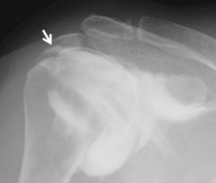 This diagnostic image is a subacromial bursography of the right shoulder, utilizing x-ray radiography with a contrast medium. The image depicts the shoulder joint anatomy, including the humeral head and the subacromial space. A key clinical finding is a localized focal pooling of radiopaque contrast medium within the tendon area of the rotator cuff, specifically indicated by a white arrow. This distribution of contrast indicates a bursal-side partial-thickness rotator cuff tear, likely involving the infraspinatus tendon. The contrast medium clearly delineates the soft tissue defect where the fluid has extravasated from the subacromial bursa into the tendon substance. This imaging modality is used here to identify pathology that may not be clearly visible on standard MRI, particularly for patients presenting with refractory shoulder impingement symptoms. The educational focus is on the diagnostic utility of bursography in identifying longitudinal bursal-side tears through characteristic contrast pooling.