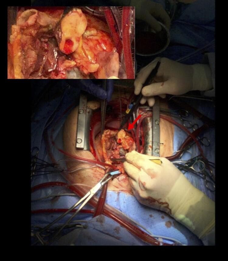This clinical photograph captures an intraoperative view of an open cardiac surgical site during a complex cardiothoracic procedure. The image depicts a sternotomy with the heart exposed and a surgical field maintained by a metal rib retractor. An inset in the upper-left corner provides a magnified view of the primary pathology: a significant aortic root abscess. This abscess is characterized by localized, yellowish-white purulent material and necrotic tissue extending from the aortic valve area toward the left main truncus. A red arrow indicates the specific involvement of the circumflex artery, which is encased in a sheath of pus. The surgical environment includes essential equipment such as cardiopulmonary bypass cannulae (red tubing carrying blood), an electrocautery device held by a surgeon, and various surgical clamps and forceps. The educational focus is on the visual manifestation of infective endocarditis complications, specifically the formation of perivalvular abscesses and the surgical anatomy of the aortic root.