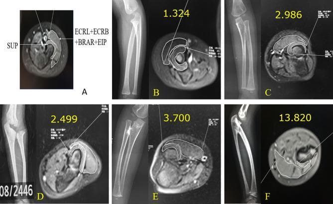 This composite educational graphic displays a series of radiographs and corresponding transverse MR images of the proximal forearm, illustrating a classification system for congenital proximal radioulnar synostosis (PRUS). Image A demonstrates the methodology for cross-sectional area measurement, targeting the supinator muscle (SUP) and a combined group of peripheral muscles (ECRL, ECRB, BRAR, and EIP). Panels B through F show a progressive spectrum of anatomical severity and their associated 'supinator ratios.' Panel B represents a normal forearm anatomy with clear separation of the radius and ulna and a ratio of 1.324. Panels C and D illustrate fibrous pseudo-synostosis (Type I), where the radial head is identifiable but articulatory dynamics are abnormal. Panels E and F demonstrate osseous synostosis (Types II and III), showing bony fusion between the radius and ulna, radial head dislocation or absence, and significantly elevated supinator ratios (up to 13.820). This visual series emphasizes the correlation between skeletal deformity and compensatory or dysplastic muscle volume changes, critical for pediatric orthopedic assessment and surgical planning.