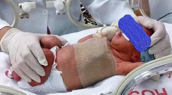 Clinical photograph of a newborn infant in a neonatal intensive care unit (NICU) setting, illustrating methods of manual and mechanical restraint for physiological monitoring. The infant is positioned in a dorsal decubitus (supine) posture within an incubator. Key clinical features include a tan elastic bandage wrapped circumferentially around the mid-torso to provide gentle abdominal and thoracic restraint, and a blue phototherapy eye shield protecting the infant's eyes. A healthcare professional wearing white nitrile gloves is seen performing manual restraint at the infant's feet. The infant is wearing a standard disposable diaper and is lying on a white sterile sheet. In the background, NICU infrastructure is visible, including incubator access ports, transparent plastic shielding, and medical monitoring tubing. This image demonstrates standard neonatal care positioning and restraint techniques used during clinical evaluations, such as heart rate variability (HRV) or vital sign monitoring in a controlled environment.