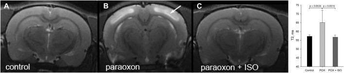This diagnostic imaging panel features three T2-weighted coronal MRI scans of rat brains alongside a quantitative bar graph, illustrating neuroprotective effects against organophosphate poisoning. Panel (A) displays a control brain with normal, uniform signal intensity. Panel (B) represents a paraoxon-treated animal (POX), showing prominent, bilateral hyperintensities in the neocortex (indicated by a white arrow), which is pathognomonic for cytotoxic edema and fluid accumulation 24 hours post-exposure. Panel (C) shows a rat treated with both paraoxon and a brief high-dose (5%) of isoflurane (ISO), where the cortical signal intensity is restored to near-control levels, indicating prevention of cerebral edema. The accompanying bar graph quantitatively confirms these findings, showing a statistically significant increase in T2 values (ms) in the paraoxon-only group compared to both the control and the isoflurane-treated groups (p < 0.005). The image demonstrates the efficacy of volatile anesthetics in mitigating neurodegeneration and swelling following toxic chemical insult to the central nervous system.