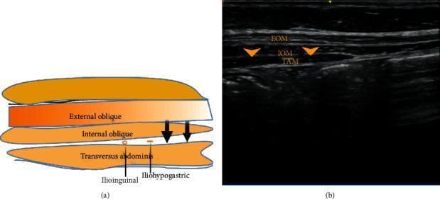 This dual-panel image features an anatomical diagram (a) and a corresponding ultrasound scan (b) demonstrating the regional anatomy for ilioinguinal and iliohypogastric nerve blocks. The diagram illustrates the layered musculature of the lateral abdominal wall, identifying the external oblique, internal oblique, and transversus abdominis muscles. It highlights the ilioinguinal and iliohypogastric nerves situated in the fascial plane between the internal oblique and transversus abdominis muscles. The ultrasound scan provides a clinical diagnostic view of the same region, showing the three muscle layers as distinct hypoechoic bands separated by bright, hyperechoic fascial planes. Specifically, the external oblique muscle (EOM) is the most superficial, the internal oblique muscle (IOM) is the intermediate layer, and the transversus abdominis muscle (TAM) is the deepest layer. Arrows on both panels indicate the target site for local anesthetic infiltration between the IOM and TAM, essential for effective regional anesthesia in the inguinal and pelvic regions.