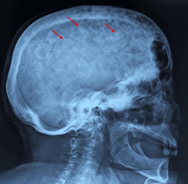 This lateral skull X-ray demonstrates a classic 'cotton wool' appearance of the cranium, a hallmark radiographic finding of Paget's disease of bone (osteitis deformans). The image shows diffuse thickening of the calvarium with a characteristic mottled texture. Multiple, ill-defined sclerotic patches are visible throughout the skull (highlighted by red arrows), representing areas of disordered, high-density bone formation interspersed with radiolucent areas of osteolysis. There is a noticeable widening of the diploic space and a loss of distinction between the inner and outer tables of the skull. The irregular mineralization replaces the normally smooth, homogeneous trabecular pattern of the cranial vault. These visual features are clinically significant as they reflect the late sclerotic phase of Paget's disease, where excessive and disorganized bone remodeling leads to structural deformities and potential neurological complications due to foraminal narrowing or cranial vault thickening.