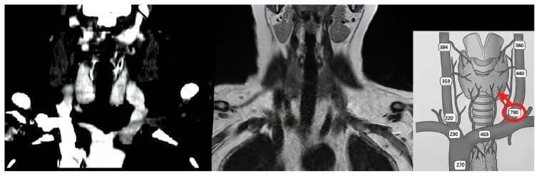 A multi-panel medical image comparing radiological modalities and physiological data for parathyroid localization. The left panel shows a coronal CT scan of the neck and upper thorax with intravenous contrast, highlighting vascular structures and bony landmarks in high-density white. The center panel displays a corresponding coronal MRI scan, offering superior soft-tissue contrast for the differentiation of cervical musculature, the thyroid gland, and neurovascular bundles. The right panel is a schematic diagram illustrating the selective venous sampling (SVS) procedure. It depicts the venous anatomy of the neck, including the internal jugular, brachiocephalic, and thyroid veins, overlaid on the thyroid and trachea. Numerical labels represent PTH (parathyroid hormone) levels measured at various catheterization sites. A red circle and arrow point to a significantly elevated PTH value (790 pg/mL) at the inferior thyroid vein, indicating the location of a hyperfunctioning parathyroid gland. This image serves as an educational tool for endocrine surgery and interventional radiology, demonstrating the integration of diagnostic imaging and biochemical sampling for precise surgical planning in primary or persistent hyperparathyroidism.