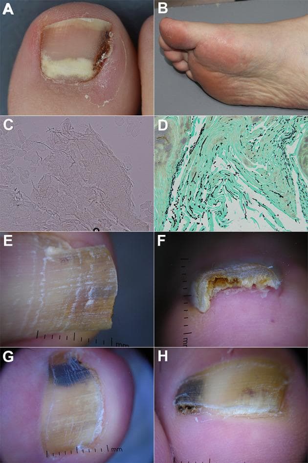 This composite educational image illustrates the clinical, diagnostic, and dermoscopic features of onychomycosis. Panel A shows a clinical photograph of proximal subungual onychomycosis with a characteristic white/yellowish opacity at the lunula. Panel B depicts plantar desquamation (tinea pedis), a common co-infection. Panels C and D show laboratory diagnostics: a potassium hydroxide (KOH) mount with visible septate hyphae (200x) and a Grocott-Gomori methenamine silver (GMS) stained nail clipping (400x) where fungal elements appear black against a green background. Panels E and F provide dermoscopic views of distal lateral subungual onychomycosis, highlighting a spiked pattern, longitudinal striae, and subungual hyperkeratosis at the distal edge. Panels G and H demonstrate fungal melanonychia via dermoscopy, characterized by a multicolor pattern including black and yellow streaks, a reverse triangular pattern (base at the distal edge), and surface scaling. The collection serves to demonstrate the integration of physical examination, microscopy, histopathology, and onychoscopy in the diagnosis of fungal nail infections.