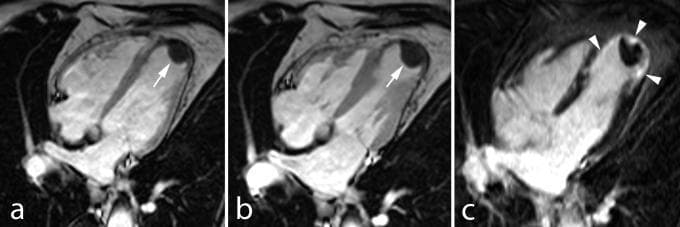 This set of three cardiac MRI (CMR) images in the horizontal long-axis (four-chamber) view illustrates the complications of an old anterior myocardial infarction in a patient with heart failure. Panel (a) is a cine MRI frame and panel (b) is an early contrast-enhanced MRI (ce-MRI), both demonstrating an apical aneurysm of the left ventricle containing a large, hypoenhanced, non-vascularized mural thrombus (indicated by arrows). Panel (c) shows late gadolinium enhancement (LGE) imaging in the same plane, which highlights transmural hyperenhancement of the apical wall (indicated by arrowheads), characteristic of replacement fibrosis and myocardial scarring. The diagnostic images provide a clinical comparison between early post-contrast sequences used to detect intracavitary thrombi and late enhancement sequences used to assess myocardial viability and infarct size. Key educational concepts include ventricular remodeling, post-infarct aneurysm formation, and the imaging characteristics of mural thrombi versus scarred myocardium.