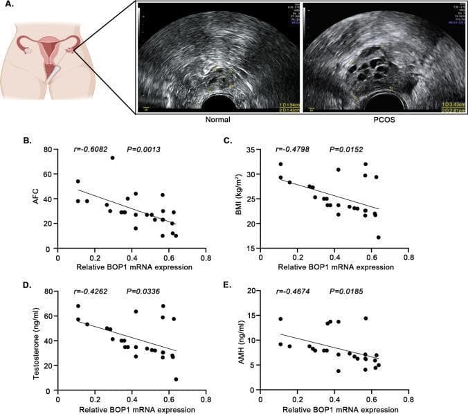This composite educational graphic illustrates the relationship between BOP1 expression and polycystic ovary syndrome (PCOS). Panel A presents an anatomical diagram of a transvaginal ultrasound procedure alongside two actual ultrasound images comparing a 'Normal' ovary to a 'PCOS' ovary. The PCOS ovary demonstrates classic diagnostic features including enlargement and a 'string of pearls' appearance with multiple peripherally located, small, hypoechoic antral follicles. Panels B through E are scatter plots with linear regression lines showing clinical correlations in PCOS patients. These graphs demonstrate that relative BOP1 mRNA expression in granulosa cells is negatively correlated with four key clinical indicators: Antral Follicle Count (AFC) (r = -0.6082), Body Mass Index (BMI) (r = -0.4798), Serum Testosterone levels (r = -0.4262), and Anti-Müllerian Hormone (AMH) levels (r = -0.4674). All correlations are statistically significant (p < 0.05). This visual data suggests that downregulation of the BOP1 gene is associated with increased severity of PCOS phenotypic markers and hormonal imbalances.