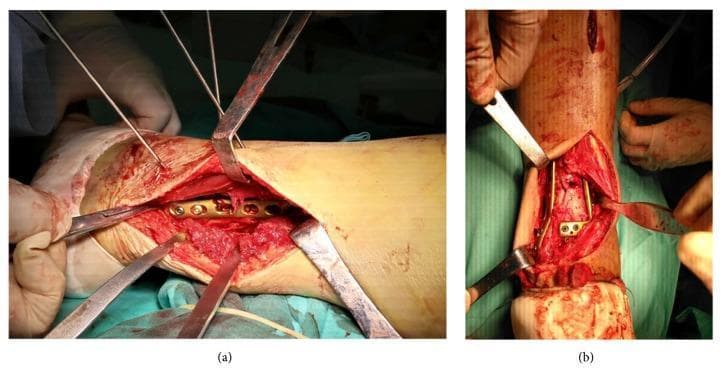A clinical photograph consisting of two panels (a and b) illustrating orthopedic surgical approaches for the internal fixation of complex ankle fractures. Panel (a) shows a posterolateral approach, with a longitudinal incision on the lateral aspect of the distal leg. Self-retaining and manual retractors expose the deep tissue layers and the posterior column of the tibia. Internal hardware, consisting of a metallic compression plate and fixation screws, is visible, secured to the bone to achieve anatomical reduction. Panel (b) depicts an anterior extensile approach with the patient in a supine position. This view demonstrates the exposure of the anterior articular surface and the distal tibia. Multiple retractors provide visualization of the fracture site, where an anterior rafting plate and screws are being utilized for stabilization. Both images highlight the importance of specific surgical corridors (posterolateral versus anterior) in managing multicomponent pilon or ankle fractures, focusing on soft tissue handling and precise anatomical hardware placement.