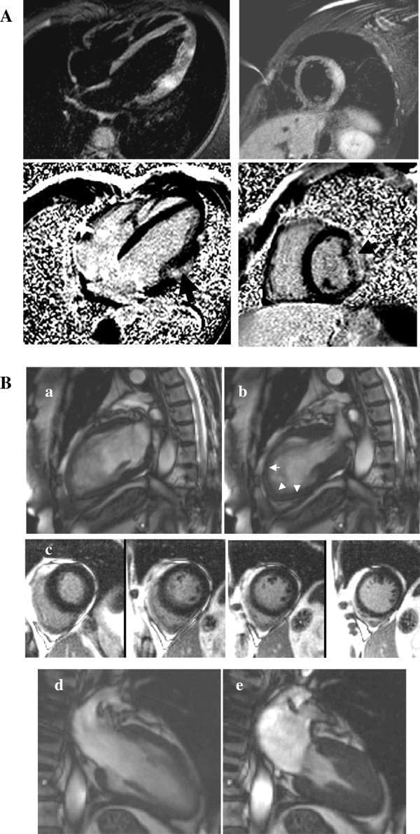 This diagnostic image provides a multi-panel Cardiac Magnetic Resonance (CMR) comparison of two acute chest pain syndromes: viral myocarditis and Tako-tsubo cardiomyopathy. Section A illustrates acute viral myocarditis using Short Tau Inversion Recovery (STIR) sequences (top) and Late Gadolinium Enhancement (LGE) sequences (middle). The STIR images (a-b) demonstrate myocardial edema as hyperintense (bright) signals in the lateral wall. Corresponding LGE images (c-d) reveal sub-epicardial enhancement (arrows), a hallmark of non-ischaemic inflammatory injury. Section B displays Tako-tsubo cardiomyopathy. The cine frames (a: diastole, b: systole) show classic 'apical ballooning' with systolic akinesia of the left ventricular apex (arrows). Middle row (c) shows a lack of LGE, distinguishing it from myocarditis or infarction. The bottom row (d-e) demonstrates full functional recovery at follow-up, with normal systolic contraction of the apex. This visual resource is designed for intermediate to advanced medical education in cardiology and radiology, focusing on differential diagnosis of cardiomyopathies through tissue characterization and wall motion analysis.