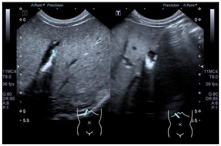This diagnostic ultrasound image displays a dual-view scan of the gallbladder within the upper right quadrant. The primary finding consists of multiple hyperechoic foci located within the dependent portion of the gallbladder lumen. These structures exhibit high echogenicity relative to the surrounding anechoic bile. Distinctive posterior acoustic shadowing is visible deep to these foci, where the ultrasound signal is attenuated, a classic hallmark of cholelithiasis (gallstones) or dense biliary sludge. The surrounding liver parenchyma appears homogeneous with normal echotexture. These images are captured using a curvilinear probe, as indicated by the sector-shaped field of view and the anatomical orientation marker showing placement in the subcostal region. The presence of these findings is clinically significant for diagnosing gallbladder pathology and distinguishing between biliary sludge and formed calculi based on the intensity of the acoustic shadow.