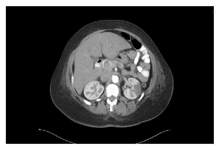 This diagnostic image is an axial contrast-enhanced CT scan of the abdomen at the level of the kidneys. The primary finding is located in the left kidney, which demonstrates multiple discrete, wedge-shaped areas of hypoenhancement in the renal parenchyma. These low-density regions extend toward the renal cortex and are classically indicative of acute renal infarction, likely secondary to embolic events. There is associated mild perinephric fat stranding adjacent to the affected areas, suggesting localized inflammatory changes. Other visible anatomical structures include the liver, which appears homogeneous, the stomach with intraluminal air, the abdominal aorta, and the spinal column. The right kidney appears normally enhanced and preserved. This visual content is highly relevant for teaching the radiological presentation of vascular-related renal pathologies and the characteristic 'wedge sign' seen in organ ischemia.