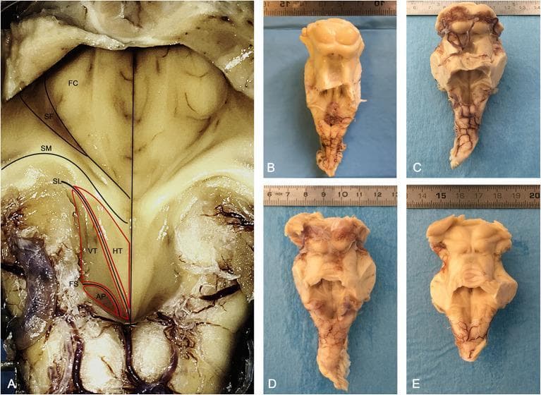 Anatomical anatomical photographs showing the posterior view of the human brainstem and the morphology of the rhomboid fossa (floor of the fourth ventricle). Image A provides a detailed, labeled view of the left half of the rhomboid fossa. Key neuroanatomical landmarks are identified: the Facial Colliculus (FC) and Superior Fovea (SF) in the pontine part; the Striae Medullares (SM) traversing horizontally; and the medullary part containing the Hypoglossal Trigone (HT), Vagal Trigone (VT or Ala Cinerea), and Area Postrema (AP). The Sulcus Limitans (SL) is marked as the longitudinal groove separating medial motor nuclei areas from lateral sensory areas, while the Funiculus Separans (FS) demarcates the Vagal Trigone from the Area Postrema. Images B, C, D, and E display four separate fixed human brainstem specimens sectioned at the mesencephalic level cranially and at the cerebellar peduncles laterally. These macro-anatomical views highlight the natural variation in the triangular shape of the rhomboid fossa and the prominence of surface landmarks like the superior and inferior colliculi. The collection serves as an educational reference for brainstem surface anatomy and the topographical arrangement of cranial nerve nuclei.
