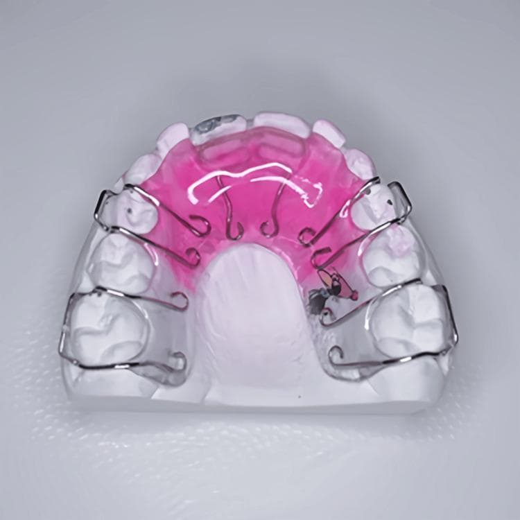 This clinical photograph displays a maxillary (upper) removable acrylic appliance seated on a dental stone cast. The appliance is a common orthodontic tool used for minor tooth movement and retention. It features a pink-tinted acrylic base plate that fits against the palate. Integrated into the anterior portion of the acrylic are two stainless steel Z-springs, positioned to apply labial pressure to the palatal surfaces of the upper central incisors for crossbite correction. For retention, the appliance utilizes four Adam's clasps constructed from thicker stainless steel wire. These clasps are strategically placed to engage the mesio-buccal and disto-buccal undercuts of the primary and permanent first molars bilaterally, ensuring the device remains securely in place during use. The image clearly demonstrates the relationship between active components (Z-springs) and retentive components (Adam's clasps) in interceptive orthodontic treatment.
