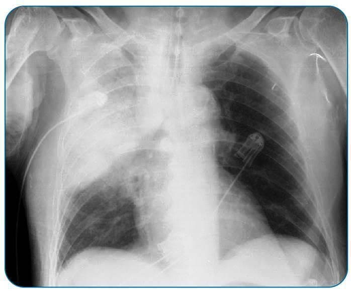 This diagnostic image is an anteroposterior (AP) chest X-ray of an adult patient. The primary finding is an extensive, dense homogeneous opacification occupying the right upper and middle lung zones, characteristic of lobar consolidation. Notable radiographic signs include the presence of air bronchograms—branching lucent tubular structures within the opaque area—indicating patent airways surrounded by alveolar exudate. There is a visible inferior displacement and convex bulging of the minor fissure (bulging fissure sign), suggesting an inflammatory process with significant volume expansion, often associated with aggressive bacterial infections such as Klebsiella or Acinetobacter pneumoniae. The left lung remains relatively clear with normal bronchovascular markings. Several medical devices are present, including an endotracheal tube, a right-sided jugular central venous catheter, and ECG leads. The diaphragmatic domes and costophrenic angles appear visible but partially obscured on the right side. This image serves as a classic educational example of acute lobar pneumonia with severe pulmonary involvement and signs of inflammatory pressure within the thoracic cavity.
