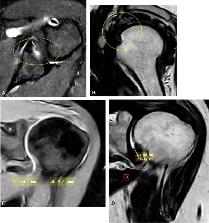 This composite of magnetic resonance imaging (MRI) scans illustrates diagnostic findings for adhesive capsulitis (frozen shoulder) across four planes. Panel A shows an oblique axial fat-suppressed proton density (PD)-weighted image demonstrating anterior and posterior extracapsular edema, indicated by hyperintense signals within the yellow circle. Panel B displays an oblique sagittal T2-weighted image showing partial obliteration of the subcoracoid fat triangle (encircled), a key indicator of proliferative soft tissue in the rotator interval. Panels C and D provide oblique coronal views used for quantitative assessment. Panel C (fat-suppressed PD) illustrates the measurement of the joint capsule's thickness at both the humeral and glenoid portions of the axillary recess (4.87 mm and 7.54 mm). Panel D (T2-weighted) shows the measurement of the axillary recess's maximal height and width (1.98 mm and 8.22 mm). These imaging modalities are critical for evaluating capsular thickening, edema, and recess volume loss in patients with clinical shoulder stiffness.