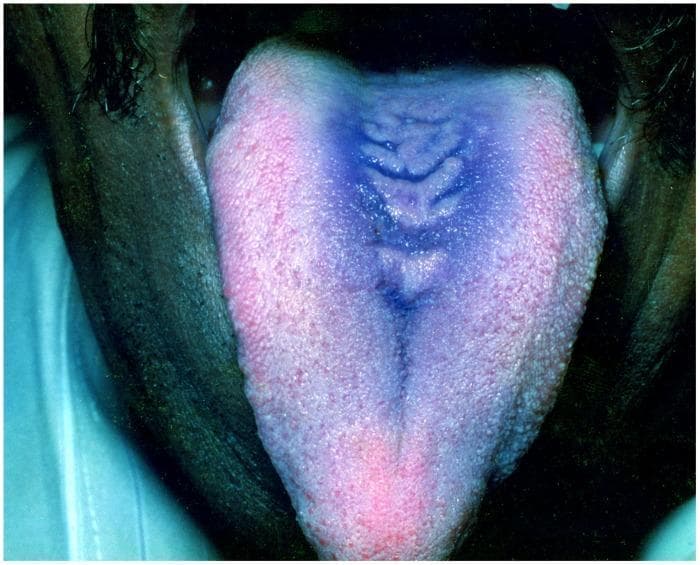 This clinical photograph displays the dorsal surface of a human tongue, demonstrating a well-defined lesion characteristic of Median Rhomboid Glossitis. The primary finding is an elongated, rhomboid-shaped area of erythema and depapillation located in the midline of the posterior third of the tongue. The central affected region appears more intensely pigmented with a blue-purple hue and exhibits a corrugated or fissured texture with several horizontal ridges. This contrasts with the surrounding light pink, granular appearance of the normal filiform papillae. The lesion represents a localized area of atrophy, often associated with chronic erythematous candidiasis. A prominent longitudinal median lingual sulcus is also visible extending from the apex toward the posterior region. This image is used for dental and dermatological education to distinguish benign midline tongue lesions from other forms of glossitis or oral malignancies.
