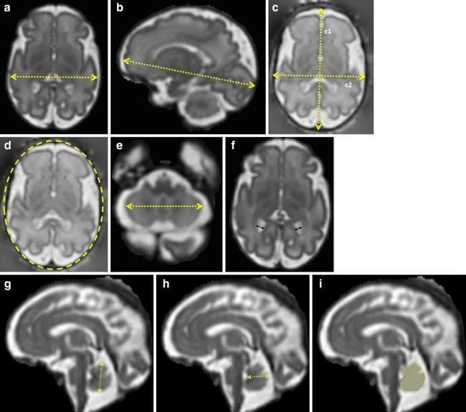 This diagnostic image panel consists of nine fetal magnetic resonance imaging (MRI) views (labeled a-i) demonstrating standardized 2D biometry of the fetal head and brain. The images comprise axial and mid-sagittal planes. Axial views illustrate measurements for the brain biparietal diameter (a), skull occipitofrontal and biparietal diameters (c), head circumference via elliptical tracing (d), transverse cerebellar diameter (e), and atrial diameter of the lateral ventricles (f). Sagittal views focus on the brain fronto-occipital length (b) and posterior fossa structures, specifically the cerebellar vermis. Vermis biometry includes the vertical height (g), width from the fastigium to the posterior border (h), and total cross-sectional area indicated by a shaded overlay (i). Yellow dashed lines and cursors define the measurement axes. This educational resource demonstrates the precise anatomical landmarks and plane orientations required for quantitative fetal neuroimaging assessment, facilitating the monitoring of gestational growth and the detection of central nervous system abnormalities.