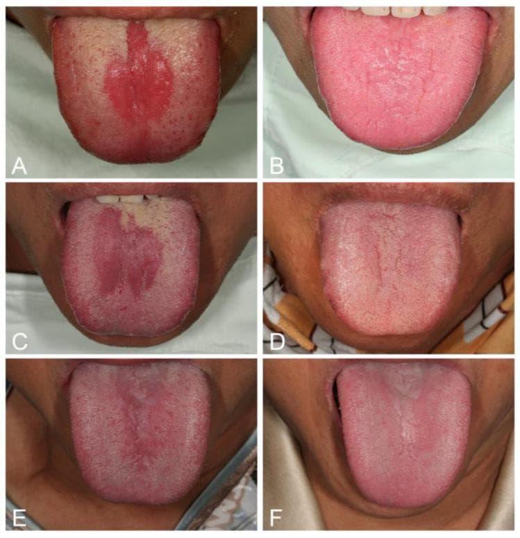 This composite clinical photograph displays six intraoral images of the dorsal tongue, illustrating three cases of Median Rhomboid Glossitis (MRG) as a manifestation of erythematous candidiasis. Panels A, C, and E represent the pre-treatment state, showing well-defined, centrally located erythematous lesions on the posterior dorsal tongue along the midline. These lesions are characterized by atrophy of the filiform papillae, resulting in a smooth, red, rhomboid, or elliptical surface area. Panel C additionally exhibits a focal white coating suggestive of pseudomembranous candidiasis. Panels B, D, and F show the same patients two weeks following combined iron and antifungal (nystatin) therapy, demonstrating complete resolution of the erythema and successful regeneration of the lingual filiform papillae. The images highlight the clinical appearance of atrophic glossitis associated with systemic risk factors like iron deficiency anemia and diabetes mellitus, and the efficacy of targeted antimicrobial and nutritional intervention in restoring normal lingual mucosal texture and coloration.