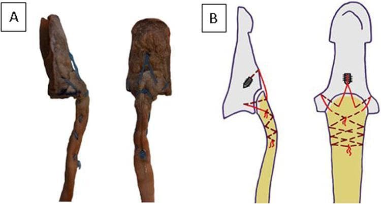 This educational image displays a clinical photograph and a corresponding anatomical diagram illustrating a surgical repair technique for a bony avulsion of the flexor digitorum profundus (FDP) tendon. Panel A shows lateral and volar views of a human cadaveric distal phalanx and FDP tendon. The repair utilizes blue suture material woven through the tendon and anchored to an avulsed bone fragment. Panel B provides a sagittal and volar schematic of a novel repair method using a suture anchor. The diagram depicts a threaded anchor embedded in the distal phalanx with red suture lines following a specific path: exiting the bone, passing through the reduced avulsed fragment, and securing the tendon using a Bunnell crisscross suture technique. Key educational concepts include the 'deadman theory' of anchor placement at a 45-degree angle and the use of tension banding principles to achieve stable interosseous attachment. This material is designed for orthopedic and hand surgery education, demonstrating techniques for managing Jersey Finger or similar distal phalanx tendon injuries.