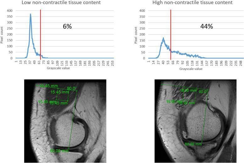 This composite educational graphic illustrates the methodology for quantifying non-contractile tissue within the vastus medialis muscle using T1-weighted magnetic resonance imaging (MRI). The image displays two clinical scenarios: 'Low non-contractile tissue content' and 'High non-contractile tissue content.' Below each sagittal MRI slice of the knee/distal femur, corresponding histograms show pixel distribution based on grayscale values (0–255). A square Region of Interest (ROI) is positioned on each MRI, standardized at 80.00 mm above the joint space. In the low-content example (6%), the histogram shows a sharp peak below the threshold value of 60, indicating dense contractile muscle tissue. In the high-content example (44%), the histogram displays a broader, flattened distribution with more pixels exceeding the 60-grayscale threshold, representing increased intramuscular fat or fibrous infiltration. Green annotations on the MRI indicate precise ROI dimensions (15.45 mm and 18.90 mm) and anatomical positioning. This comparison demonstrates the use of digital image analysis for assessing muscle quality and pathological changes in musculoskeletal radiology.