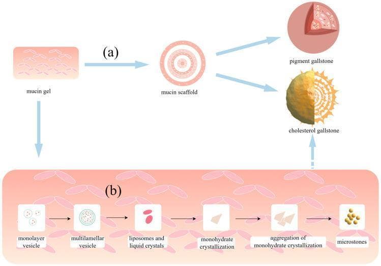 A medical pathophysiology diagram illustrating the mechanisms of gallstone formation mediated by mucin. Section (a) shows the progression from a highly viscous mucin gel to a structured mucin scaffold, which serves as a matrix for the development of both pigment gallstones and cholesterol gallstones. Section (b) details the step-by-step nucleation and growth pathway of cholesterol gallstones within the mucin environment. The process begins with monolayer vesicles transitioning into multilamellar vesicles, which then fuse into liposomes and liquid crystals. This leads to monohydrate crystallization, followed by the aggregation of these crystals to form microstones. These microstones eventually mature into larger macroliths or cholesterol gallstones. The diagram highlights the role of mucins as essential scaffolds and accelerators for vesicle fusion and crystal nucleation in supersaturated bile. Key medical concepts depicted include biliary lithogenesis, the biochemical transition of cholesterol vesicles, and the structural influence of the mucin network in the gallbladder.