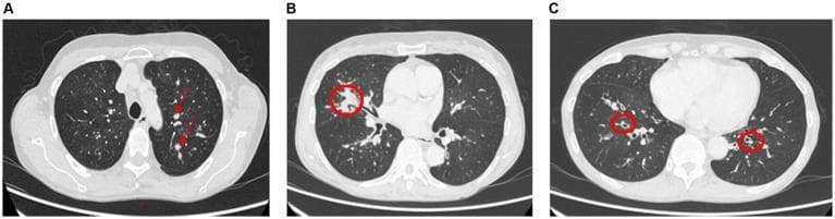 Diagnostic axial computed tomography (CT) scans of the chest demonstrating classic radiological features of Allergic Bronchopulmonary Aspergillosis (ABPA). Panels A and B illustrate high-attenuation mucous plugging within the airways of the left upper lobe and right middle lobe (indicated by red arrows and a circle). These plugs appear as nodular or mass-like densities that obstruct the bronchial lumen, a finding that can lead to distal lobar or segmental collapse and impaired ventilation. Panel C shows proximal bronchiectasis in the lower lobes (highlighted by red circles), characterized by abnormal bronchial dilation near the central airways rather than the lung periphery. This combination of central bronchiectasis and mucoid impaction is a hallmark diagnostic feature for ABPA in patients with a history of asthma or cystic fibrosis. The images highlight the primary role of high-resolution CT in identifying the structural airway changes and mechanical obstructions associated with pulmonary hypersensitivity reactions to Aspergillus species.
