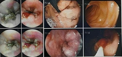 A series of endoscopic images from an upper gastrointestinal endoscopy (esophagogastroduodenoscopy) demonstrating severe esophageal pathology. The images reveal multiple deep esophageal ulcers with irregular borders and fibrinopurulent exudates. Significant esophageal varices (Grade IV) are visible as tortuous, dilated blueish-pink protrusions within the esophageal lumen, indicating portal hypertension. Some frames show congestive gastropathy with erythematous, mottled mucosa typical of portal hypertensive changes. Signs of recent or active hemorrhage and luminal narrowing due to mucosal edema and variceal bulk are also observed. These findings are clinically significant in the context of extrahepatic portal vein obstruction, highlighting the risk of upper GI bleeding and the compensatory collateral circulation development secondary to portal venous system thrombosis.