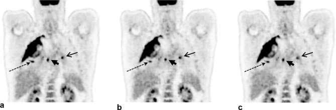This Comparison Chart displays three coronal PET scan images (a, b, and c) of the human torso, demonstrating the impact of respiratory gating on diagnostic image quality. The modality highlights metabolic activity using a grey scale representing Standardized Uptake Value (SUV) from 0 to 6. Anatomical landmarks include the liver (showing high radiotracer uptake), kidneys, spine, and pulmonary regions. Image (a) shows the scan without motion compensation, where thoracic lesions indicated by arrows appear blurred and elongated along the cranio-caudal axis due to respiratory motion. Image (b) utilizes data-driven quiescent period gating (DDG), and image (c) utilizes externally driven (RPM) quiescent period gating. In both (b) and (c), the motion-compensated images show significantly improved lesion clarity, better definition of lesion morphology, and higher overall image contrast compared to the non-gated image (a). This clinical example illustrates how respiratory gating techniques minimize motion artifacts, particularly for small pulmonary and hilar lesions, enhancing diagnostic accuracy and quantitative SUV measurements in oncology imaging.