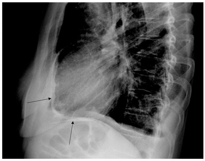 This lateral chest X-ray illustrates the diagnostic hallmarks of constrictive pericarditis. The image prominently features heavy, curvilinear calcification of the pericardium, highlighted by black arrows. These dense, radio-opaque deposits are clearly visible along the anterior and inferior borders of the cardiac silhouette, situated in the retrosternal space and above the diaphragm. Key anatomical landmarks include the sternum anteriorly, the vertebral column and ribs posteriorly, and the shadow of the heart within the thoracic cavity. The thick, white band of calcium outlining the heart is a classic radiographic sign of chronic pericardial inflammation and fibrosis, often seen as a late sequela of radiation therapy or chronic infection. This visual finding is highly suggestive of impaired ventricular filling and restrictive cardiac physiology. The educational focus is on identifying extracardiac calcification as a marker for constrictive pericarditis in patients with characteristic clinical symptoms.
