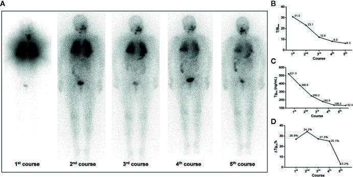 This composite educational image illustrates the longitudinal treatment response of a 68-year-old female with differentiated thyroid cancer and 131I-avid pulmonary metastases. Panel (A) displays a series of five anterior whole-body radioactive iodine (131I) scans following five successive courses of radioiodine therapy (RT). The initial scan shows intense, diffuse bilateral pulmonary uptake and thyroid bed activity. Successive scans demonstrate a progressive reduction in tracer avidity, signifying therapeutic response and decreased tumor burden. Panels (B), (C), and (D) provide quantitative correlation through line graphs. Graph B shows the maximum target-to-background ratio (T/Bmax) declining from 31.0 to 6.3. Graph C tracks the thyroid stimulating hormone-suppressed thyroglobulin (Tgon) levels, showing a significant decrease from 521.0 ng/mL to 132.0 ng/mL. Graph D illustrates the change rate of Tgon level (ΔTgon%), which peaks at 34.2% in the second course before dropping to 3.2% by the fifth course. This multimodal representation highlights the transition from biochemical remission to potential radioiodine refractoriness in late-stage treatment.